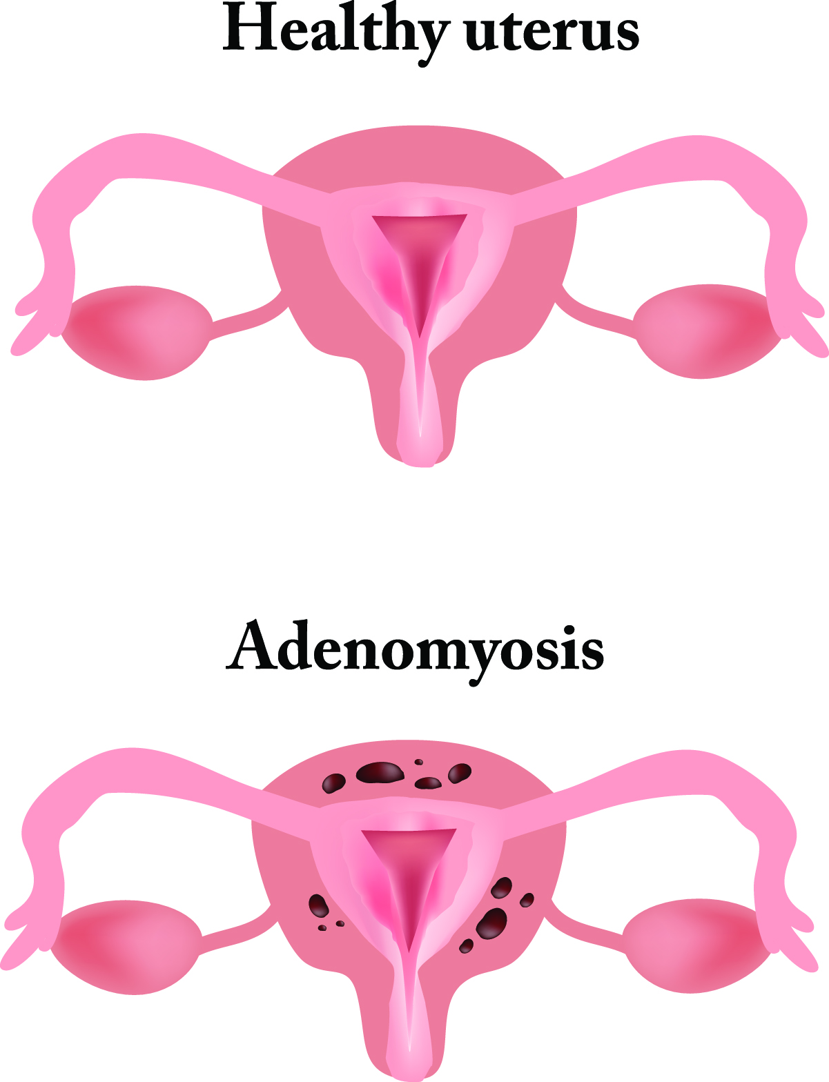 Adenomyosis - Symptoms & causes - Mayo Clinic